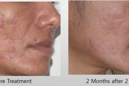 Infini-Before-After-35.jpg