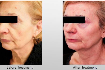 Infini-Before-After-9.jpg