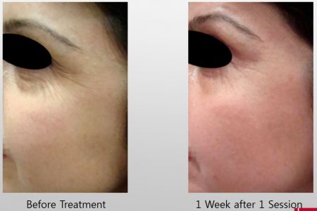Infini-Before-After-7.jpg