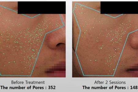Infini-Before-After-22.jpg