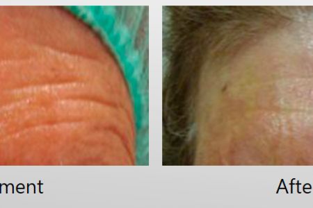 Infini-Before-After-2.jpg