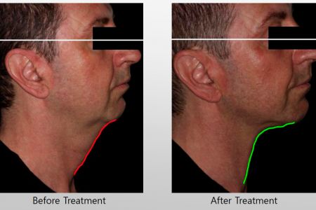 Infini-Before-After-17.jpg