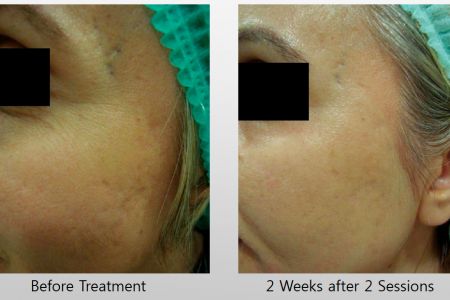Infini-Before-After-27.jpg
