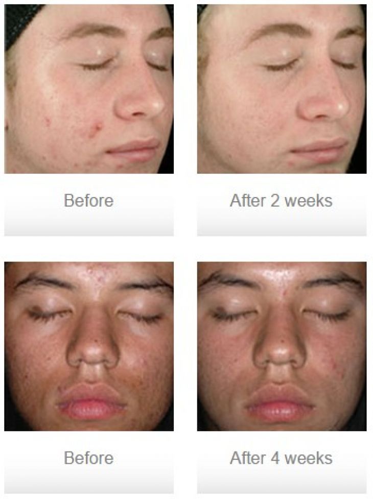 Acne Treatment before and after